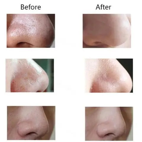 Blackhead Remover Pore Vacuume Tool - Souq Tanzeelat